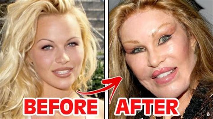 Not Eating Or Sleeping After Plastic Surgery – Hollywood Life